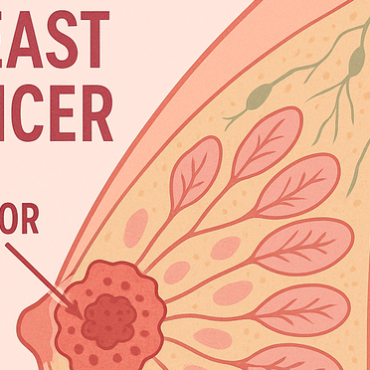 History and an overview Breast Cancer