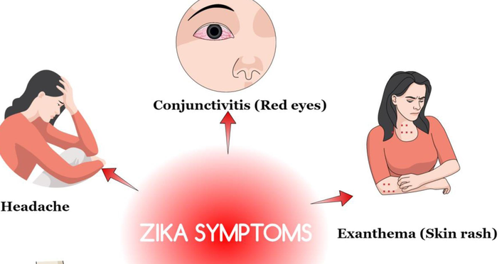Causative, symptoms and treatment of Zika disease